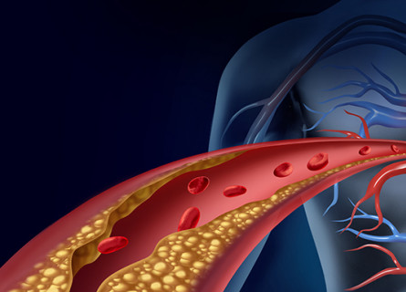 Artist's impression of plaque inside a blood vessel inside the heart.